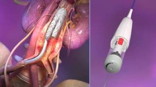 Ap0552 En1 Gore Excluder Aaa Endoprosthesis Repositionable Animation