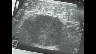 Krūties vėžio vystymasis ir diagnostika