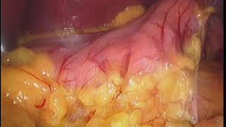 Sleeve and  Cholecystectomy unedited