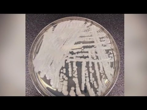 Candida auris: Where are the fungus cases in New York? What we ...