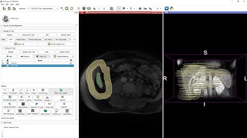 SlicerRVXLiverSegmentation - Liver segmentation by grow from seeds