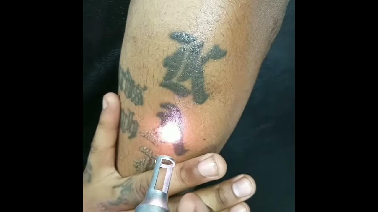 laser-tattoo-removal-in-kenya-nairobi-youtube
