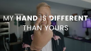 My Hand is different than yours - Disability after Accident