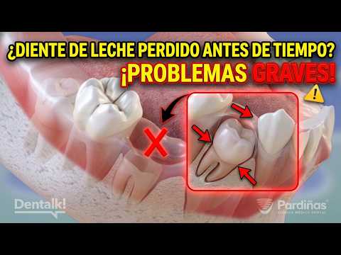 La Pérdida de Dientes de Leche de forma prematura Causa Problemas futuros