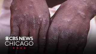 Doctors warn about uptick in mpox cases in Chicago area