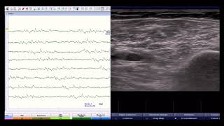 Myotonic discharge, CRD, and MUP