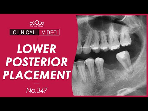 Lower posterior implant placement with bone graft [Dr. Cho