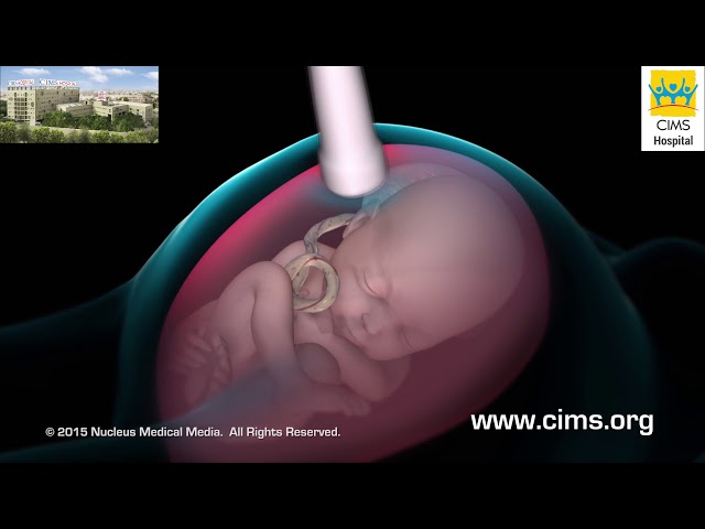 Amniocentesis (Gujarati) - CIMS Hospital