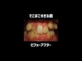歯列矯正 Orthodontics #shorts