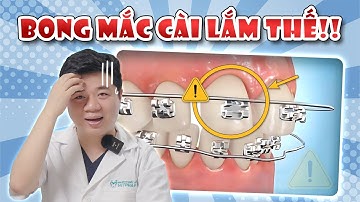 CẨN THẬN: 05 NGUYÊN NHÂN GÂY BUNG MẮC CÀI KHI NIỀNG RĂNG | CHỚ BỎ QUA