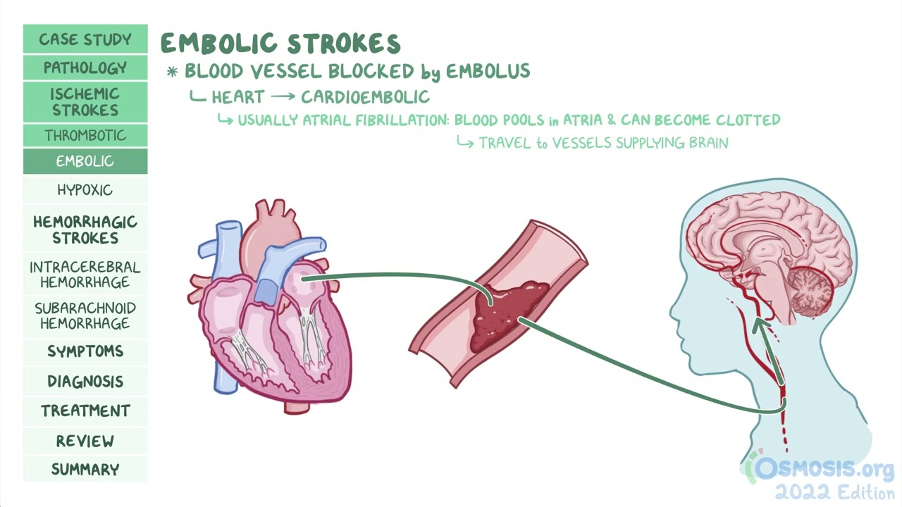 Ischemic Stroke Pathophysiology Intracerebral Hemorrhage Basic Anatomy