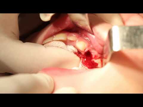 Video: Периостеотомия медициналык тилде эмнени билдирет?