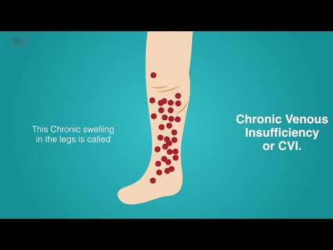 What is Chronic Venous Insufficiency (CVI?)