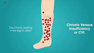 What is Chronic Venous Insufficiency (CVI?)