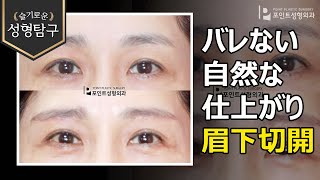 眉下切開の症例 バレない自然な仕上がり Youtube