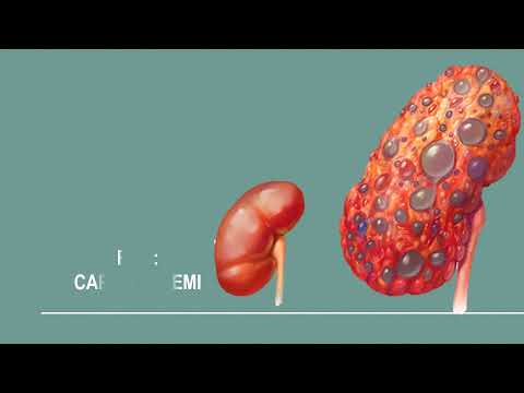 Video: Cómo tratar la enfermedad renal poliquística autosómica dominante: 9 pasos