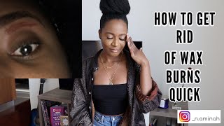 HOW TO GET RID OF EYEBROW WAX BURNS FAST!! MY EXPERIENCE.