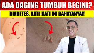 DON'T IGNORE! This Is What Warts on the Neck, Back, Armpits, or Around the Eyes Mean | Dr. Ruly