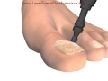 How Does Laser Toenail Fungus Removal Work?