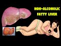 liver disease: foods that naturally cleanse the liver! non-alcoholic fatty liver disease