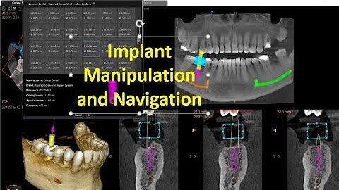 CS 3D Imaging Version 3.10.12 - Implant Planning Part 4 Implant Manipulation