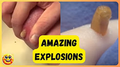 Pimples Popping Compilation: Flying Pimples, Huge Nasty Cysts