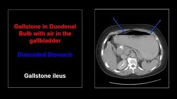 Duodenal Emergencies  | Free Radiology CME