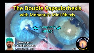 Double Capsulorhexis for intumescent white cataracts (Mohanta's Mini-Rhexis)