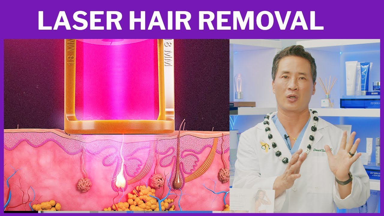 NEW LASER HAIR REMOVAL TREATMENT Dr. David Yew YouTube
