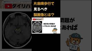 片麻痺歩行で見る必要がある脳画像とは?#理学療法士