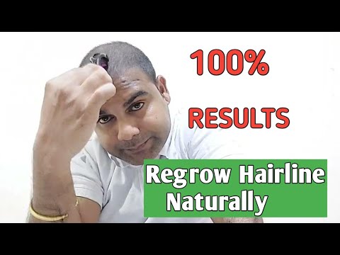 Regrow Hairline Naturally , DERMA ROLLER For Hair Growth For Men ...
