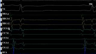 Ep Workmate Recording System Training Module 6 St Jude Medical