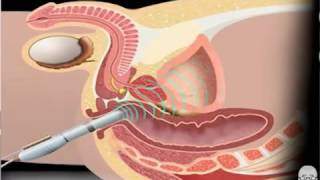 Cancer en la prostata y sus sintomas, Cancer hormonal sintomas, Cancer cerebral causas y sintomas