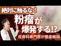 【粉瘤爆発！】絶対に押してはいけない！粉瘤を押すと危険な理由を皮膚科専門医が徹底解説