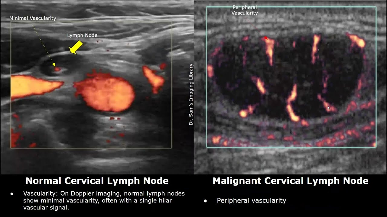 Cervical Lymph Nodes Ultrasound Normal Vs Abnormal Images Reactive Cervical Lymph Nodes Ultrasound Normal Vs Abnormal Images Reactive