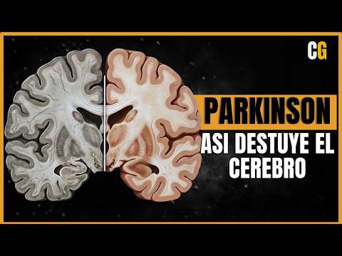 Parkinson ¿Cómo Destruye el Cerebro? - Muy Parecido a los Priones
