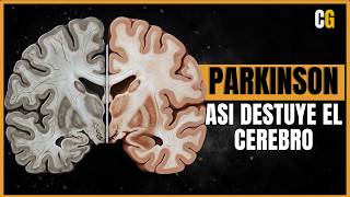 Parkinson ¿Cómo Destruye el Cerebro? - Muy Parecido a los Priones