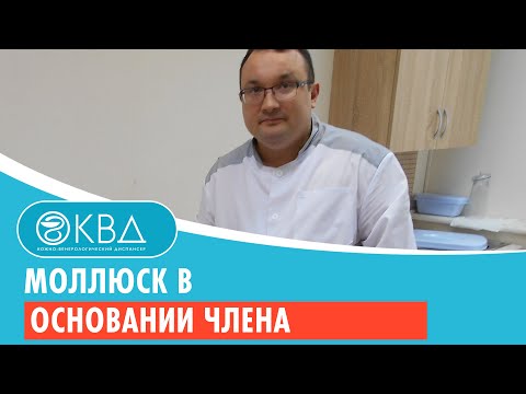 ? Моллюск в основании члена. Клинический случай №206