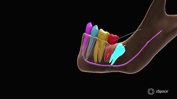 DistoAngular Impaction