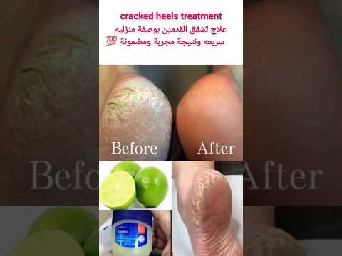 علاج تشقق القدمين بسرعه     تشقق القدمين   