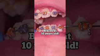 Braces at 10 years old - I still have Baby Teeth - Tooth Time Family Dentistry New Braunfels Texas