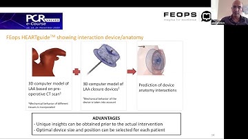 Left Atrial appendage closure with Amulet ™by Dr. Adel Aminian