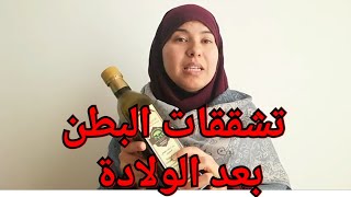 طريقة سهلة للتخلص من تشققات البطن بعد الولادة