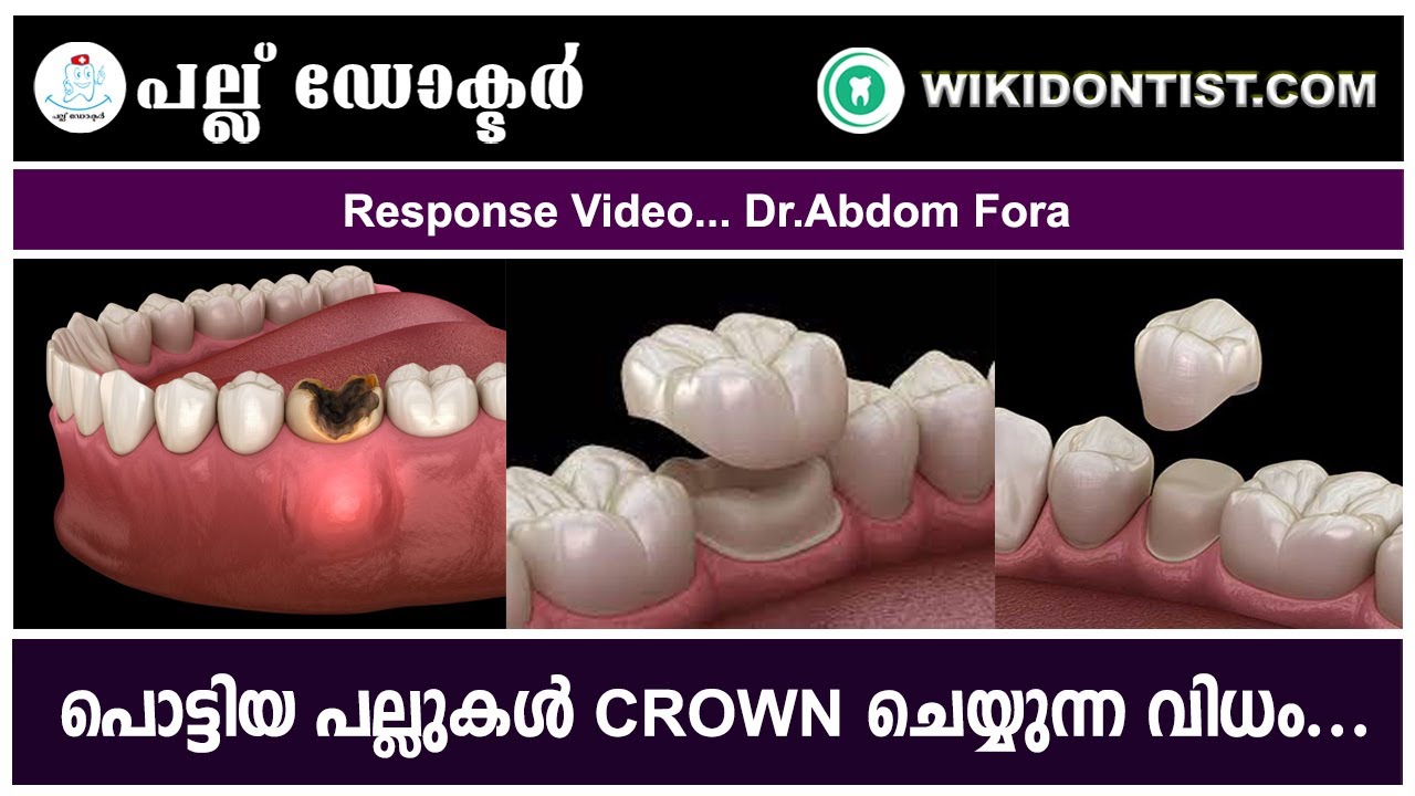 പൊട്ടിയ പല്ലുകൾ CROWN ചെയുന്ന വിധം .... Response Video... Dr.Abdom Fora..., By Dr.Thomas Nechupadam