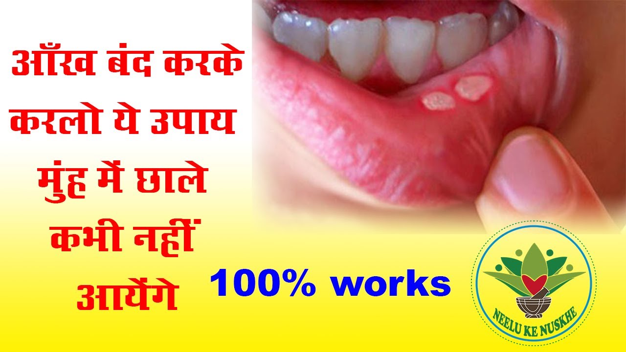 what to do for an ulcer in your mouth what to do for an ulcer in your mouth