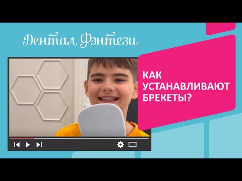 😬 Процесс установки брекетов в Дентал Фэнтези