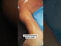 LIPO HD NOS BRAÇOS! 😱 Veja essa definição impressionante ainda na mesa de cirurgia!