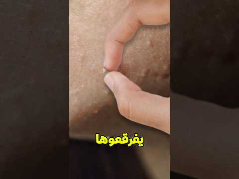 لو طلعتلك حباية اوعي تفرقعها