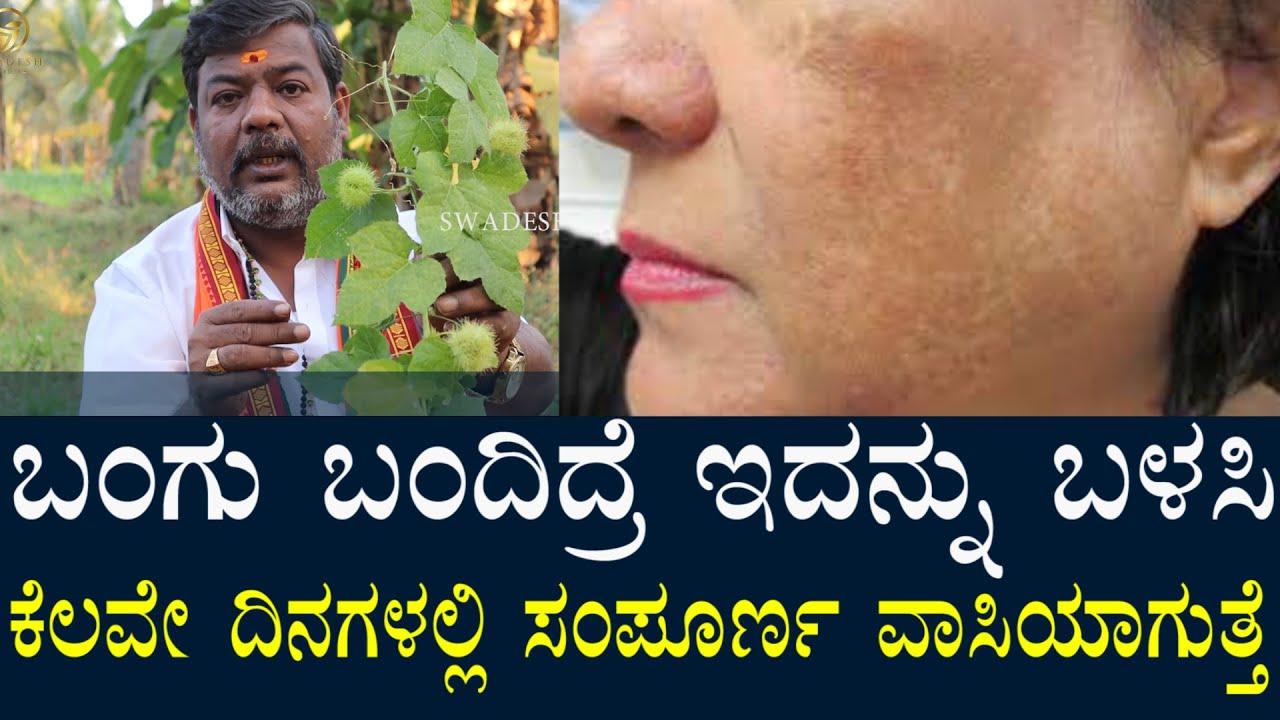 ಬಂಗು ಬಂದಿದ್ರೆ ಈ ಬಳ್ಳಿಯಿಂದ ಪರಿಹಾರವಿದೆ? ಹೇಗೆ ಬಳಸುವುದು? Herbal Remedy For Face Skin Black marks