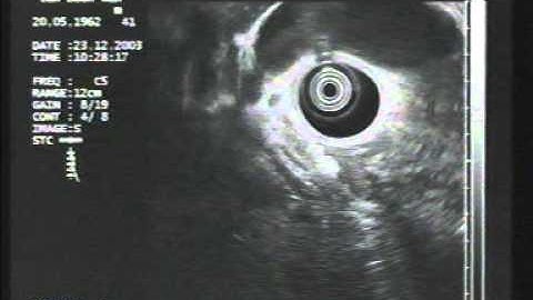 Endoscopy Master Videos: EUS cholangiocarcinoma @ www.gastroliver.com.sg